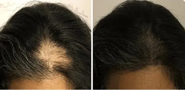 Zgostitev las pri ženskah s skalp mikropigmentacijo